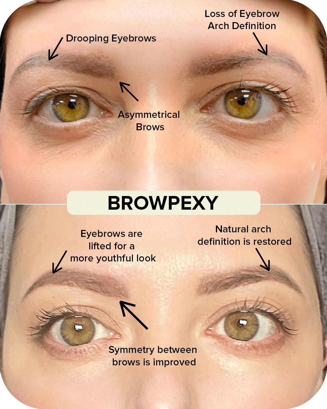 Browpexy Before and After Comparison