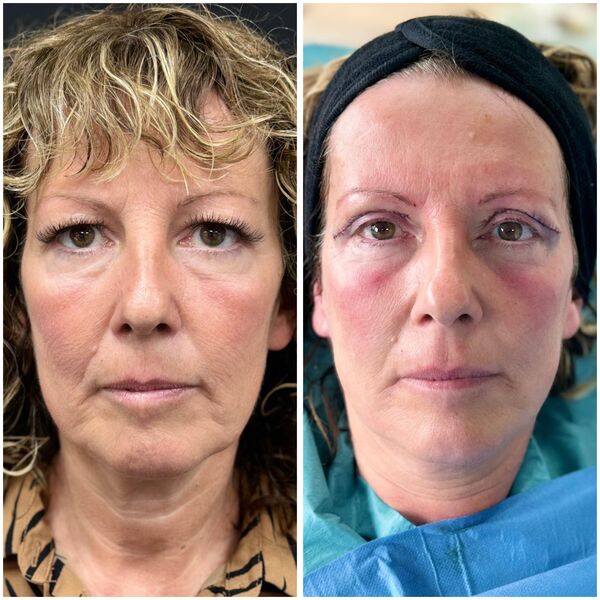 Before and after eyelid surgery results