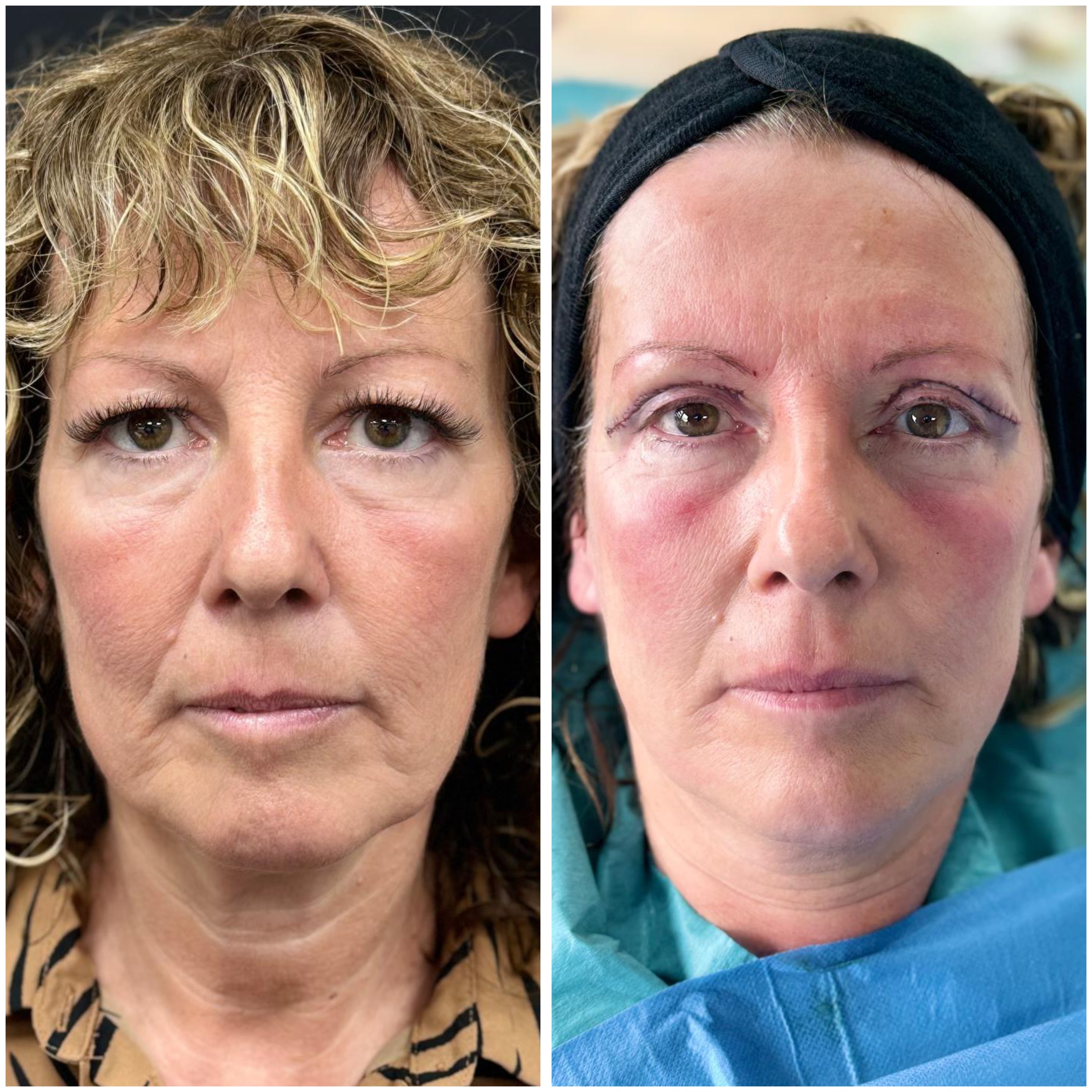 Before and after eyelid surgery results