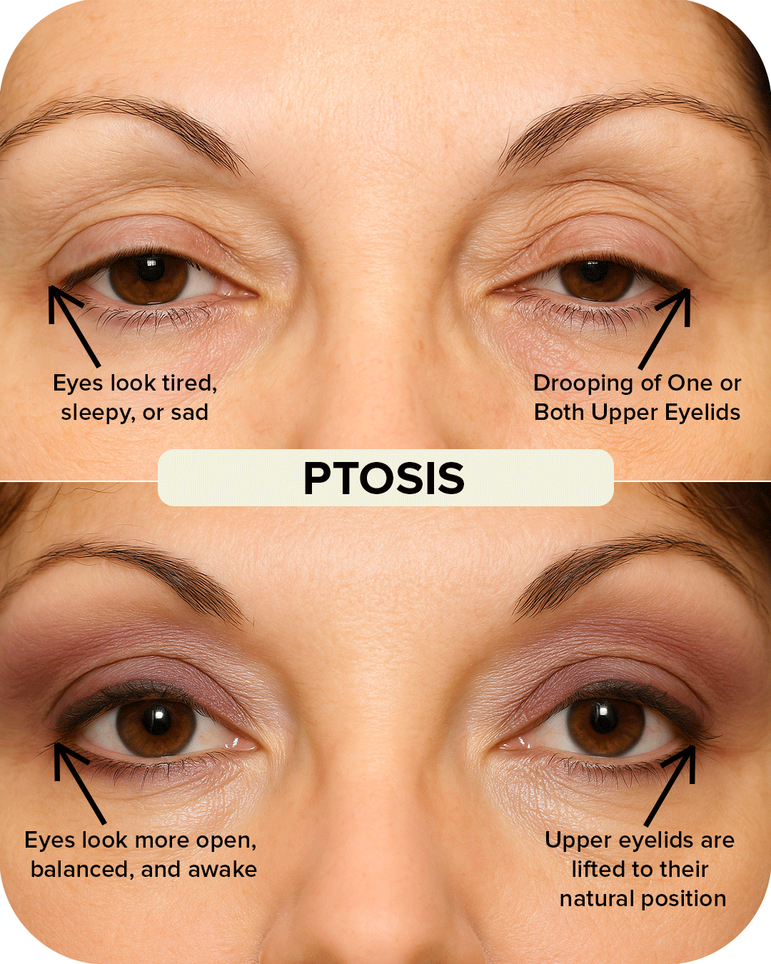 Ptosis Correction Before and After Comparison
