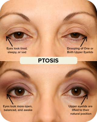 Ptosis Correction Before and After Comparison
