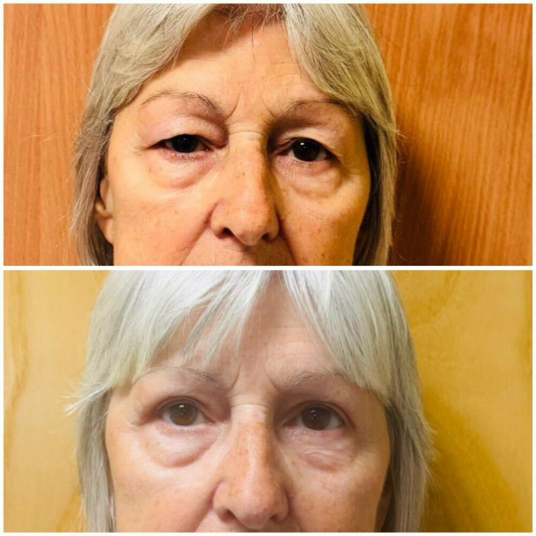 Ptosis Correction - Before & After Results