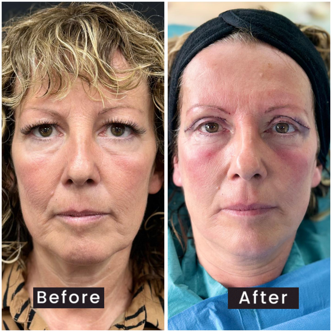 Upper Eyelid Surgery - Before & After Results