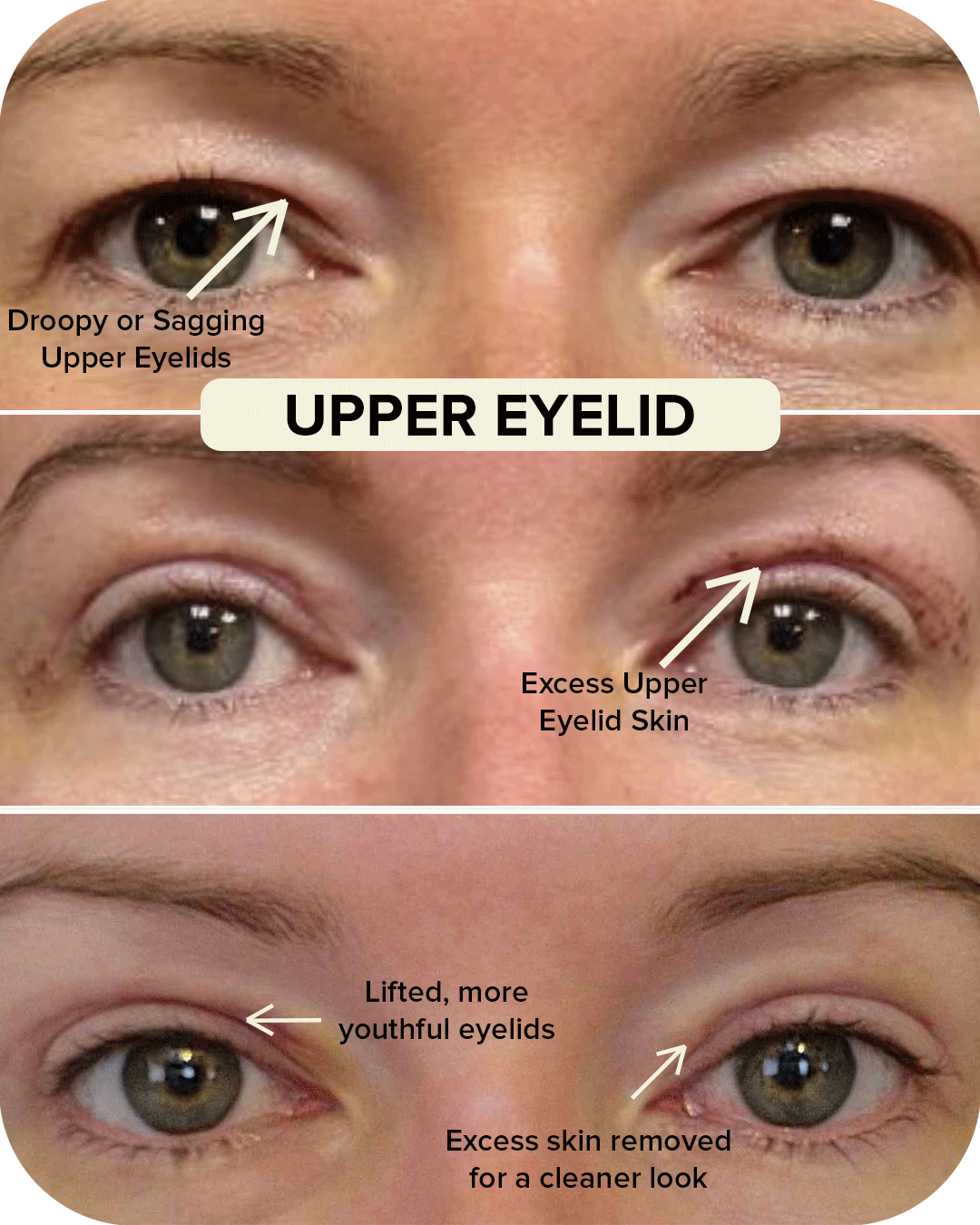 Upper Eyelid Blepharoplasty Before and After Comparison