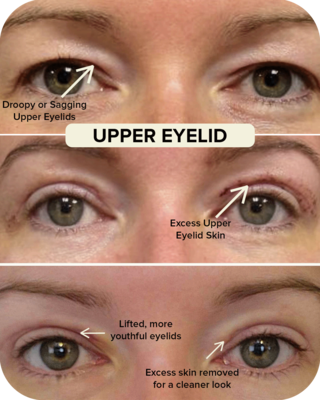 Upper Eyelid Blepharoplasty Before and After Comparison