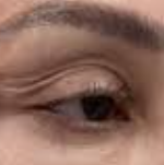 Upper Eyelid