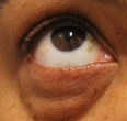 Lower Eyelid