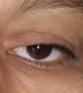 Ptosis Correction