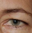 Browpexy - Brow Area