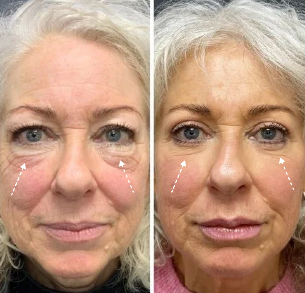 Lower Eyelid Surgery - Before & After Results