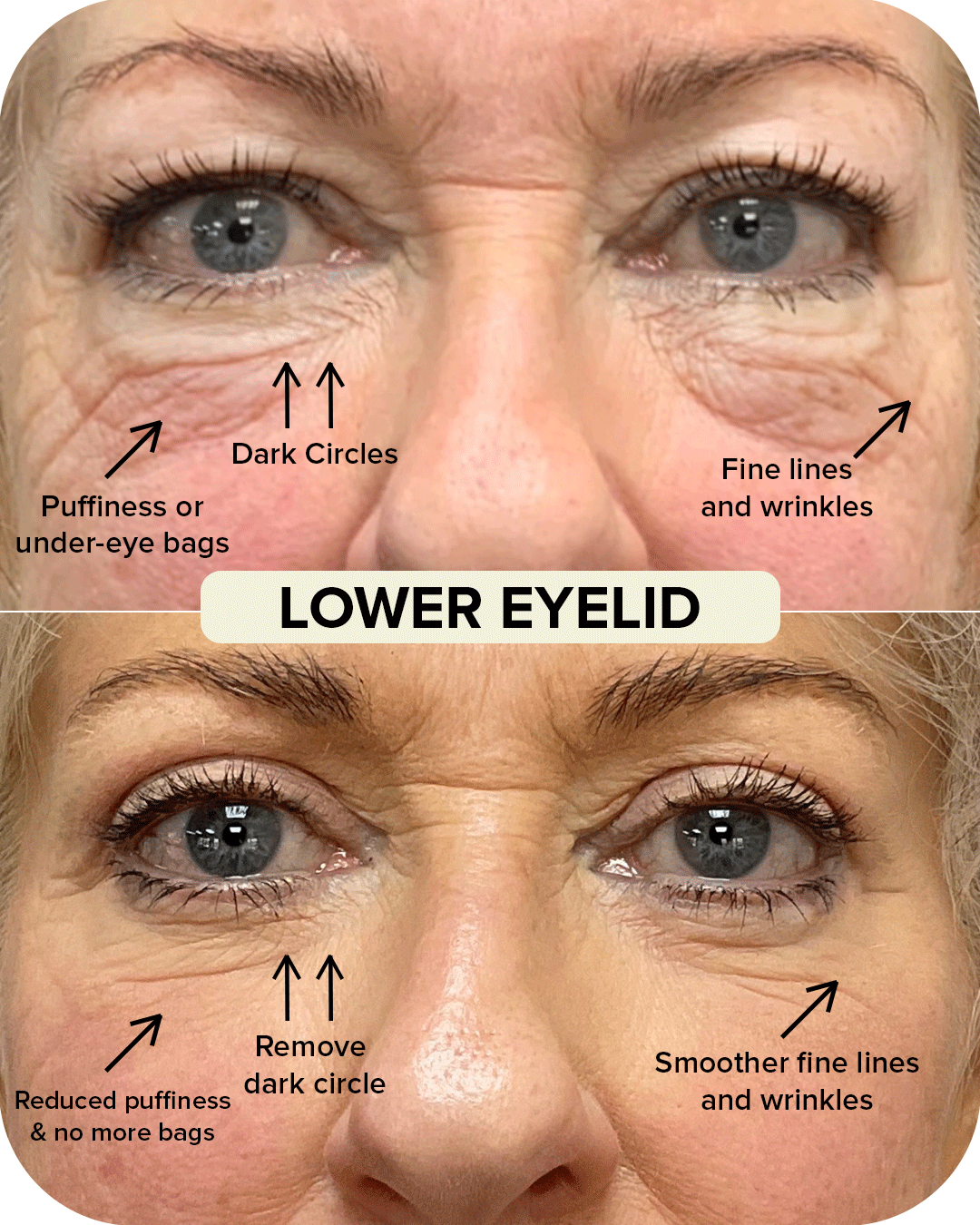 Lower Eyelid Blepharoplasty Before and After Comparison