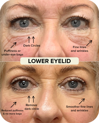 Lower Eyelid Blepharoplasty Before and After Comparison